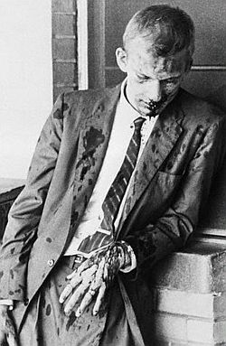May 20, 1961: Jim Zwerg, one of the Freedom Riders beaten at Montgomery, Alabama bus terminal.